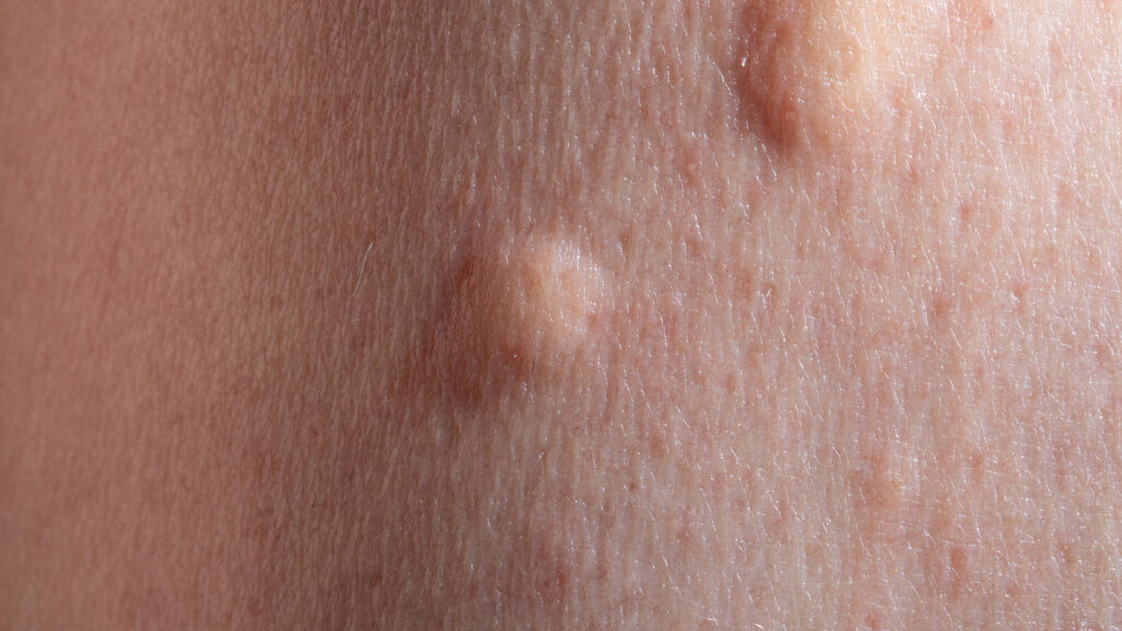 Mosquito bites